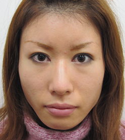 埋没法+目頭切開 術後