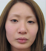 二重埋没N-L挙筋法 術前