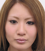 二重埋没N-L挙筋法 術後