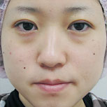 二重埋没N-L挙筋法 術後