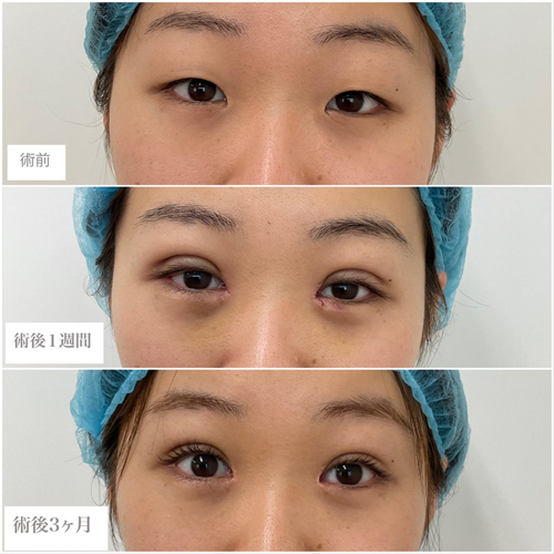 目頭切開+埋没法3点止め