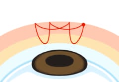二重自然治癒法 ４点交叉法図