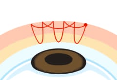 二重自然治癒法 6点交叉法図