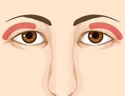 上瞼(うえまぶた)・目の上の切開法2