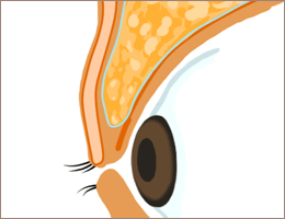 脂肪を除去 術前