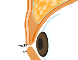 脂肪を除去 術後