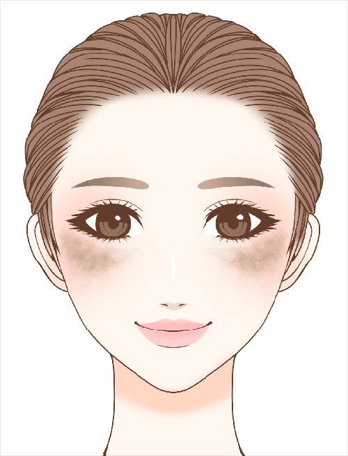 肝斑のイメージ
